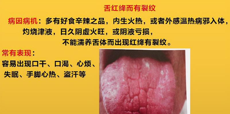 舌头裂纹的原因及预防措施（揭秘舌头裂纹的形成原因）